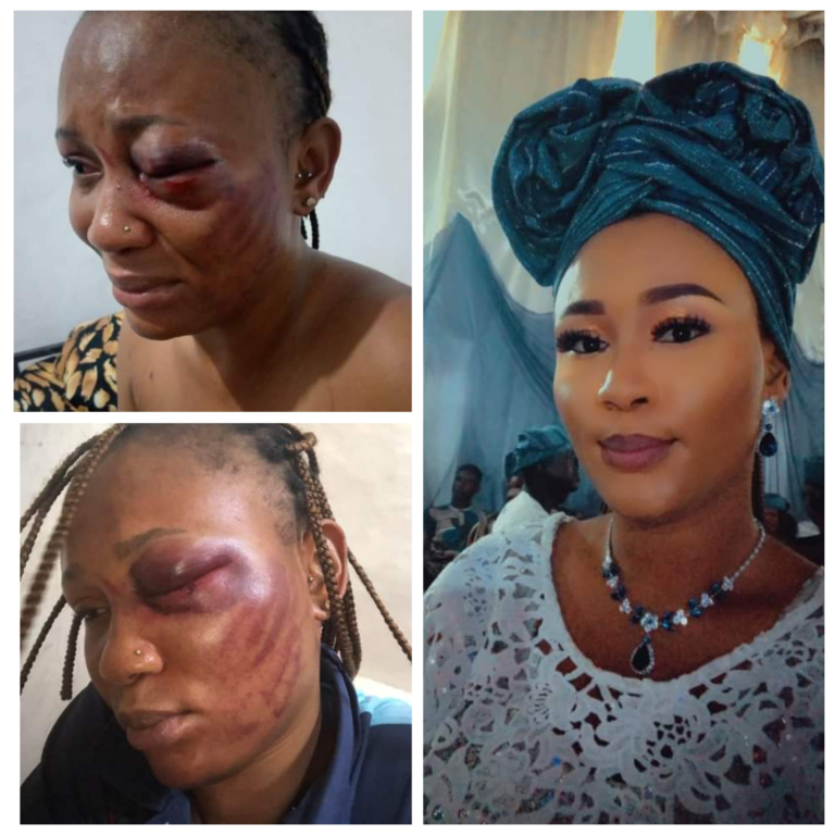 Domestic Violence: Nigerian woman cries out, says “15 years in abusive relationship with a beast has cost me my left eye”