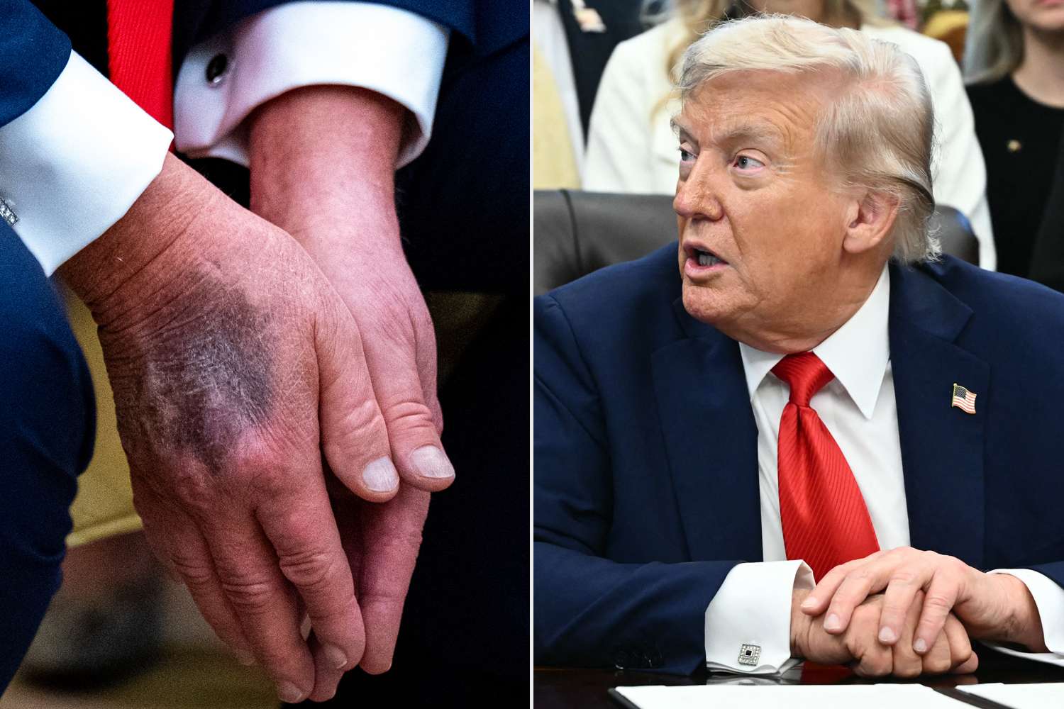 As Trump’s bruised hand sparks health rumors, he blames aspirin, denies napping